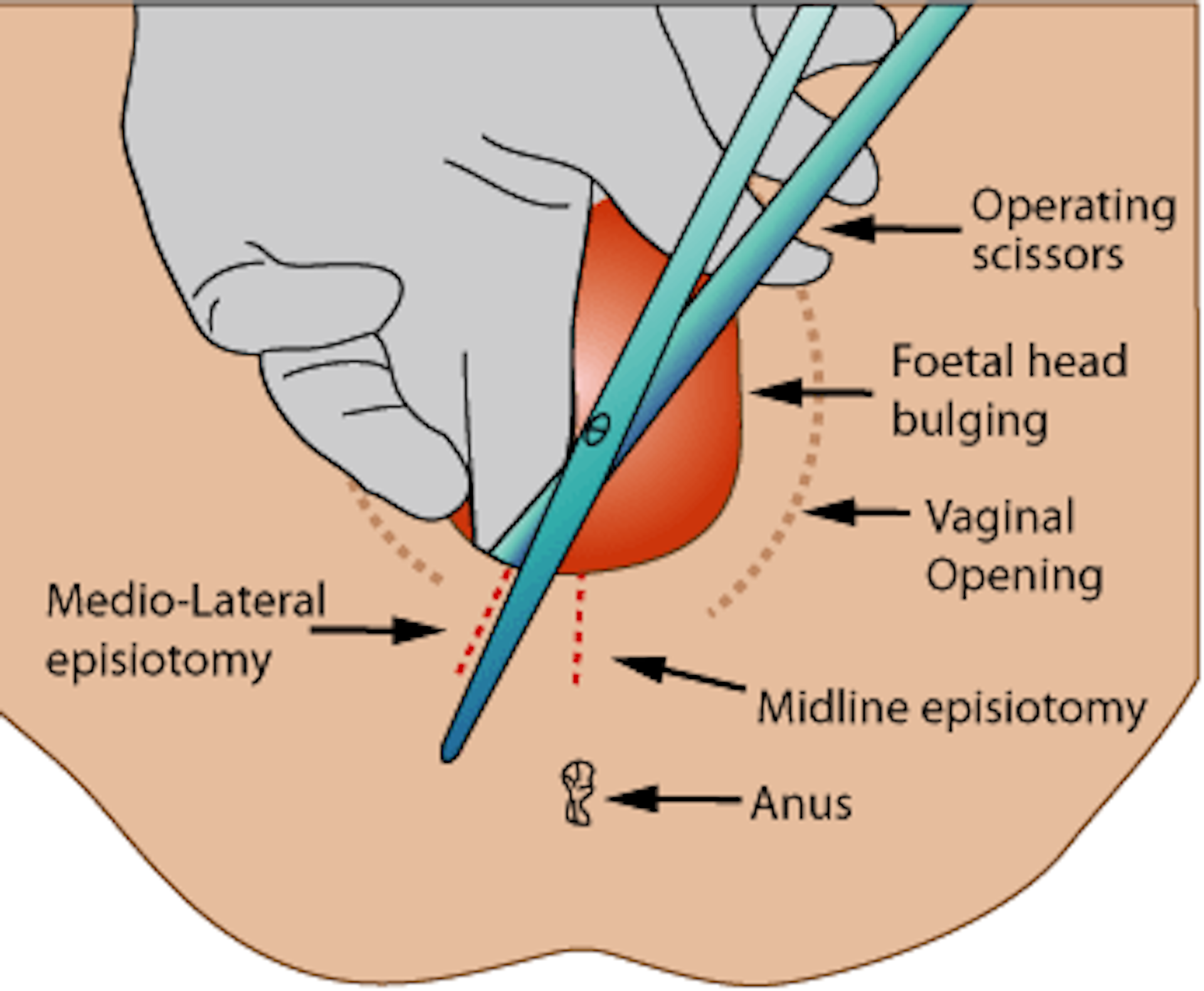 Small Cuts On Vagina